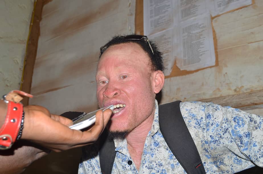 Butembo : Les albinos sont victimes de marginalisation en milieux professionnels (Muhammed Masatiro)