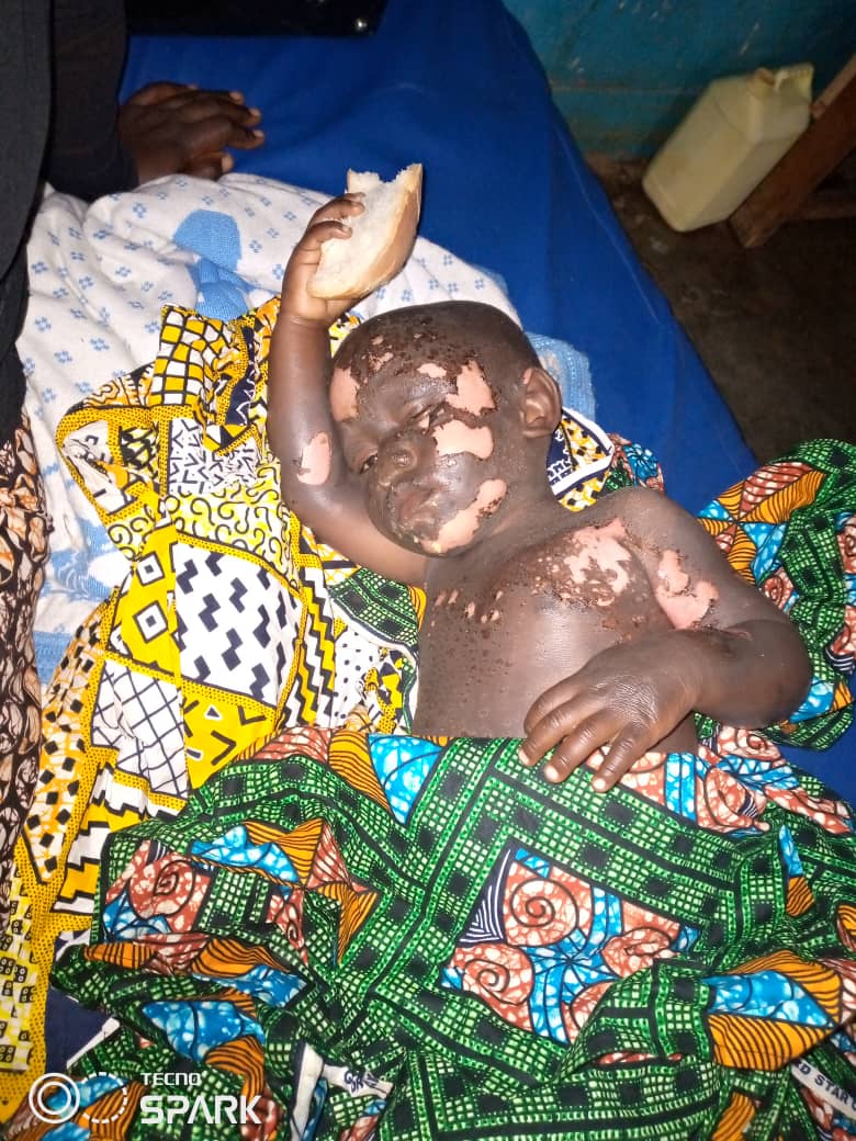 Lubero: Un coup de foudre paralyse deux enfants  à Bwatsinge
