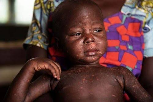 Beni: environ 3.000 Cas de la rougeole enregistrés dans la zone de santé d&rsquo;Oicha depuis septembre 2022 (Kule Kyusa)
