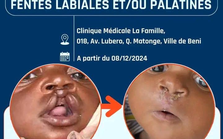 Nord-Kivu :Un rayon d&rsquo;espoir au Grand Nord, HEAL Africa offre des soins gratuits pour les fentes labiales et palatines