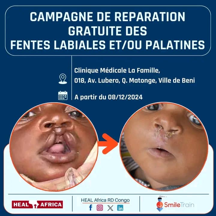 Nord-Kivu :Un rayon d&rsquo;espoir au Grand Nord, HEAL Africa offre des soins gratuits pour les fentes labiales et palatines